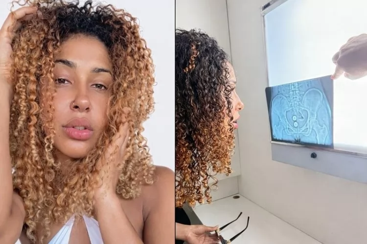 Após exibir raio-X de bolas de pompoarismo presas, influenciadora denuncia ataques misóginos nas redes