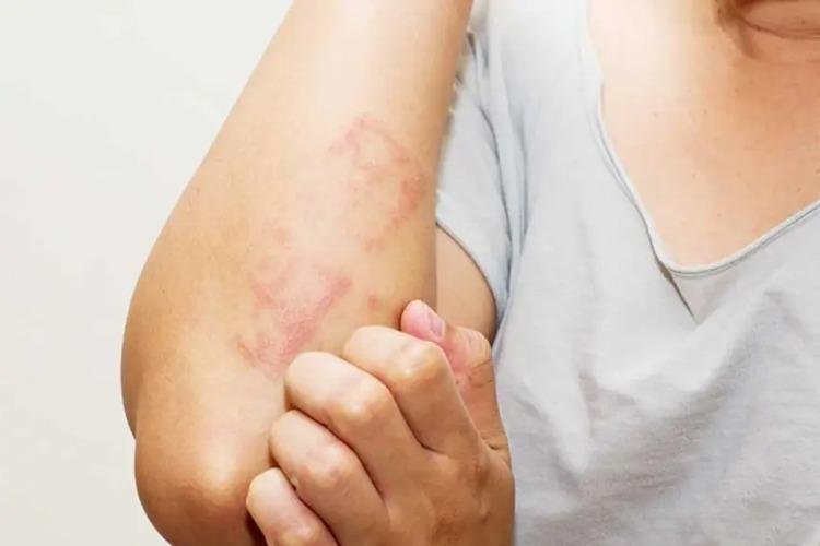 Governo do Amapá orienta sobre dermatite atópica e mostra onde buscar tratamento pelo SUS