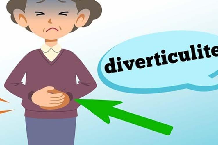 O que é diverticulite? Quando devo suspeitar?
