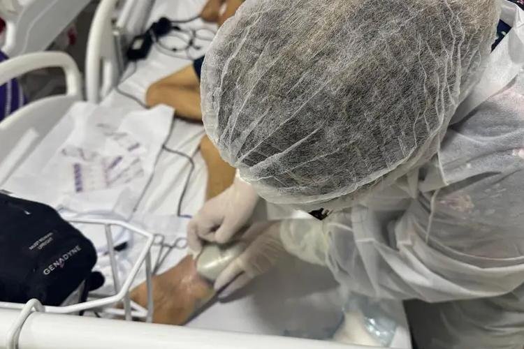 Fundação de Saúde Amapaense adota inovação tecnológica do curativo a vácuo no anexo do HE para acelerar cicatrização de feridas graves 